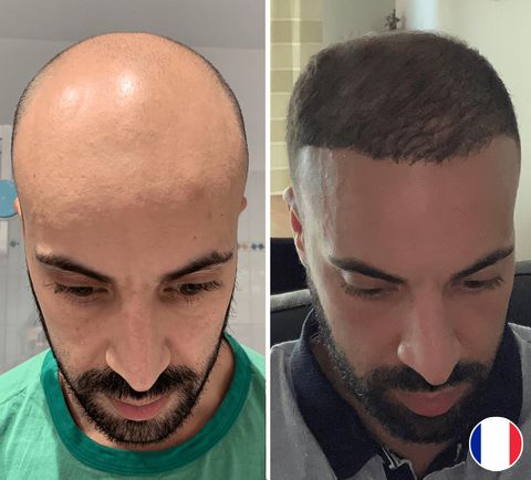 FUE Hair Transplant Experts in South Africa.pdf